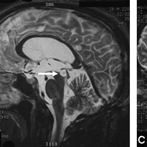 Parenchymal Cysticercosis Mri Sagittal T1wi A Axial T2wi B And C