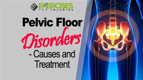 Pelvic Floor Disorders Causes And Treatments Exercises For Injuries