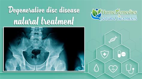 Natural Treatments And Home Remedies For Degenerative Disc Disease