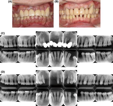 Management Of Generalized Severe Periodontitis Using Fullmouth