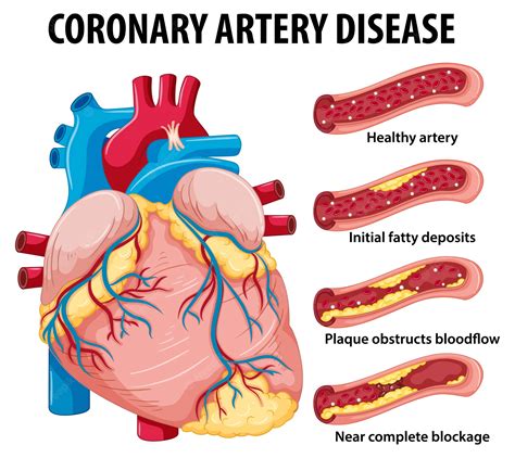 Coronary Artery Disease CAD Causes Symptoms Treatment