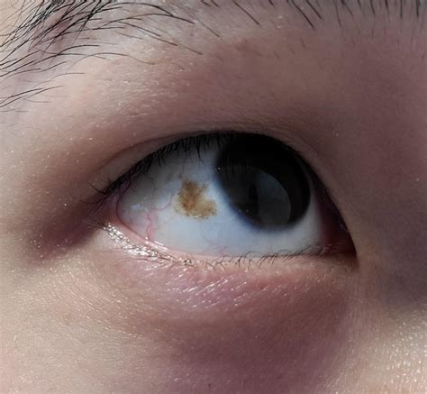 26m Brown Spot In L Eye Started As A Small Brown Fleck 8 Years Ago And Gradually Grew Larger