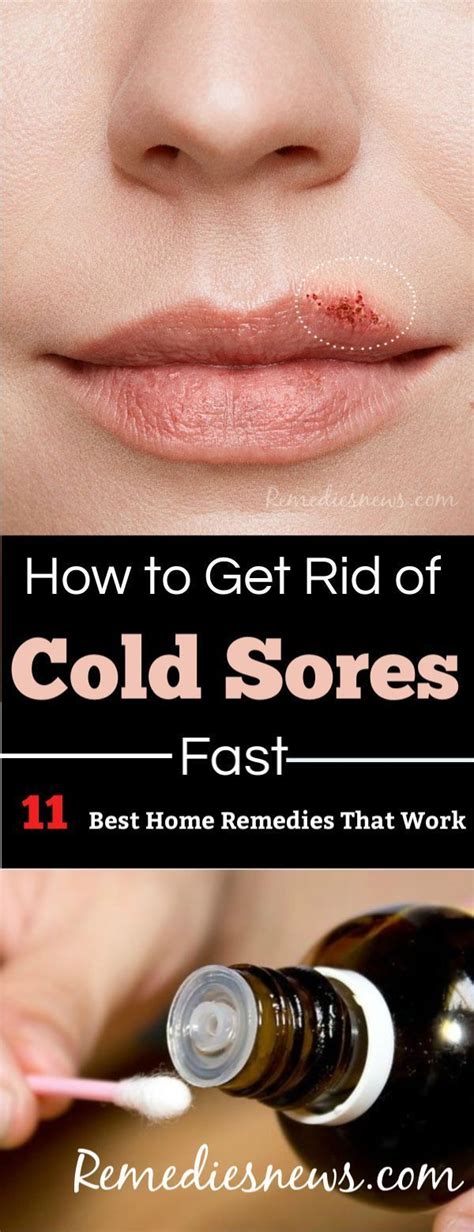 How To Get Rid Of Cold Sores Fast 11 Best Home Remedies With Images