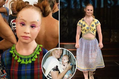 Downs Syndrome Model Who Battled Weight Woes And Struggled To Keep Up
