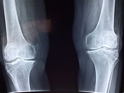 Normal Knee X Ray Anatomy