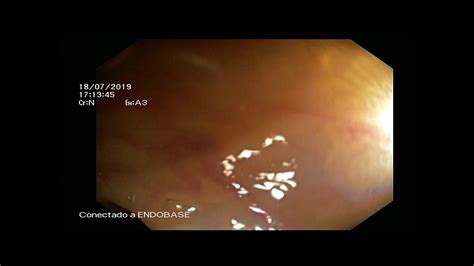 Difficult Colonoscopy Diverticular Disease Low Pressure Youtube
