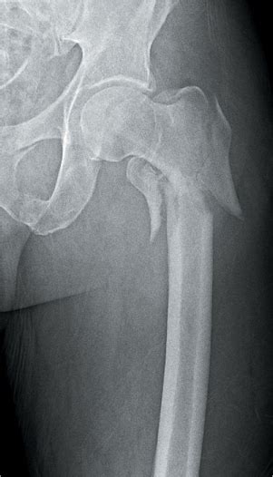Extracapsular proximal femur fractures | Musculoskeletal Key