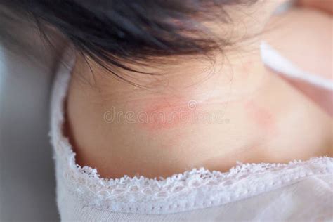 婴孩皮疹和过敏与红色斑点原因由蚊咬 库存图片 图片 包括有 ¬ä½ å© å³å¿ƒ æ˜†è™ 138130721