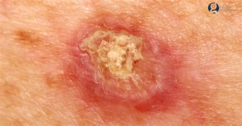 Skin cancer in cats appears as pink lesions, alopecic areas, and scabs on the skin that at first can be mistaken for wounds, but as the disease proliferates these areas of the skin acquire a more reddish color and may even appear ulcerated areas with harder edges similar to scabs. Squamous Cell Carcinoma