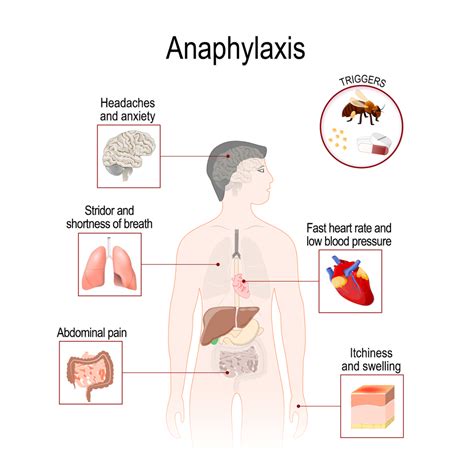 Anaphylaxis Anaphylactic Shock Nursing Review Of The Treatment Signs