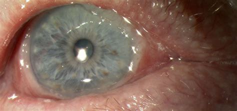 Ocular Cicatricial Pemphigoid Valerie Saw