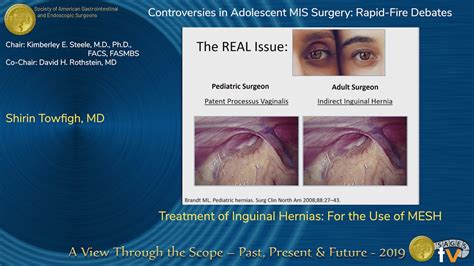 Treatment Of Inguinal Hernias For The Use Of Mesh Youtube