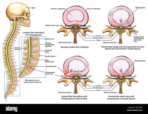 Classic Lumbar Disc Herniation With Nerve Root Impingement Stock Photo