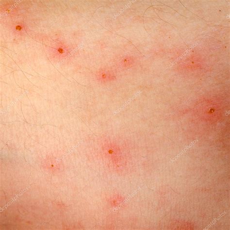 erupción alérgica dermatitis eccema piel