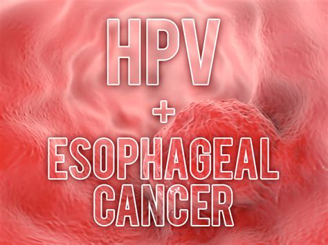 Hpv Linked To Esophageal Cancer Outcomes Medpage Today