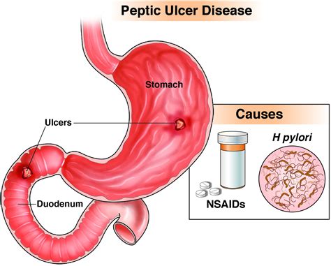 La enfermedad de úlcera péptica AGA GI Patient Center