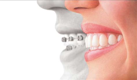 Facts About Braces Orthodontic Blog Orthodontic Specialists Of Lake