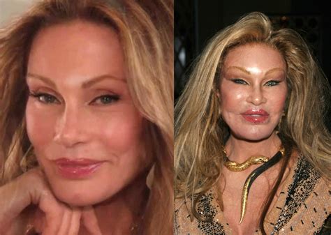 Most Expensive Celebrity Plastic Surgeries Ever And How Much They Cost Hot Sex Picture
