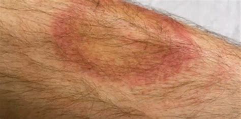 Tick Bite Pictures Symptoms Causes Treatment Hubpages