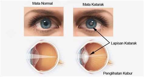 Insiden keselamatan pasien adalah setiap kejadian yang tidak disengaja dan kondisi yang mengakibatkan atau berpotensi mengakibatkan. KESEHATAN, MOTIVASI DAN INSPIRASI: LAPORAN PENDAHULUAN DAN ...
