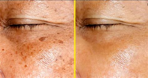 Dark Spots On Face Causes
