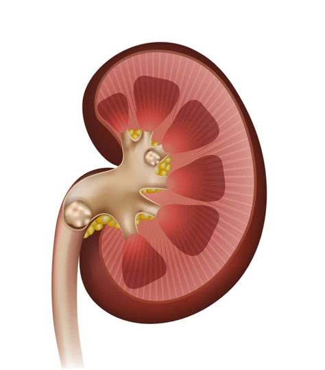 Treatment Options For A 9 Mm Renal Stone New York City Kidney Stone