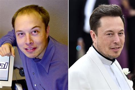 Its Highly Likely Elon Musk Spent Over 20k On Hair Transplant