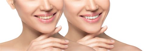 Whitening And Bleaching Dentist In North Syracuse Ny Gregory Sweeney Dds