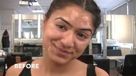 Before And After Vitiligo Transformation Youtube