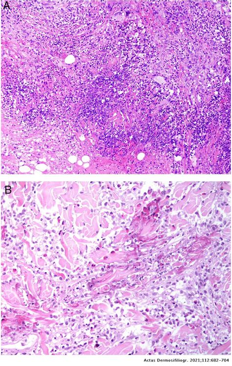 Granulomas In Dermatopathology Principal Diagnoses Part 1 Actas