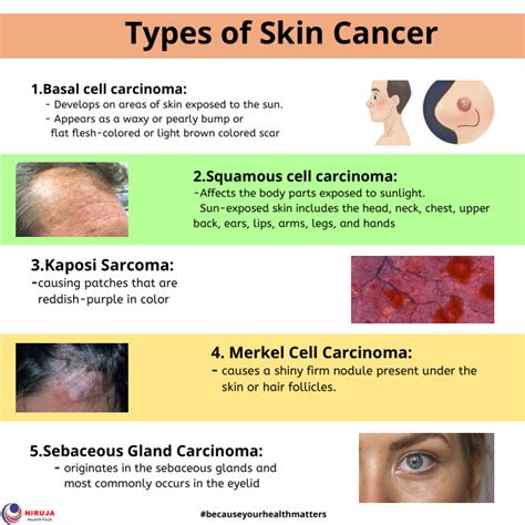 Types Of Skin Cancer Treatment
