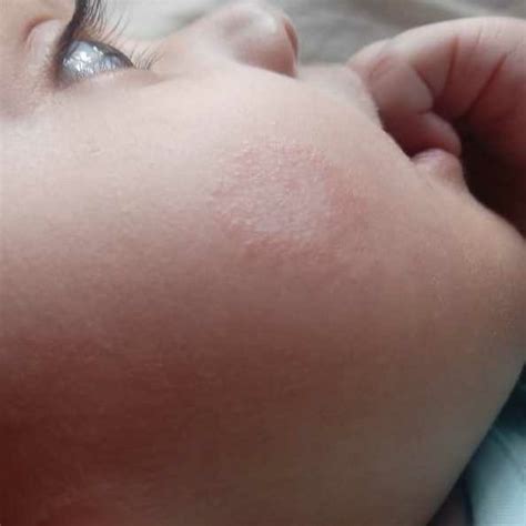 My 5 Month Old Child Has A Red Patch On Her Cheek Since 2 Weeks She
