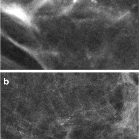 The Morphology Of Calcifications On Synthetic Mammograms Generated From
