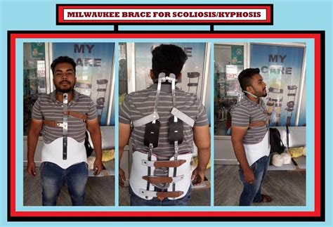 Mycaremedical Post Operative Custom Ctlso Milwaukee Brace For Personal