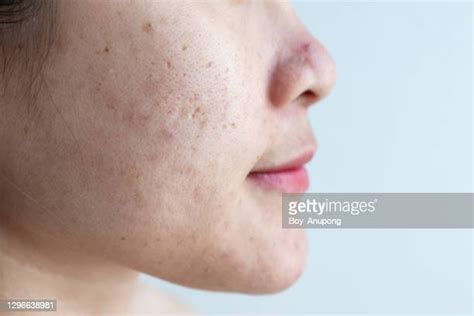 Rosacea Face Photos And Premium High Res Pictures Getty Images