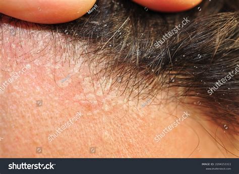 Dermatitis Scalp Over 1002 Royalty Free Licensable Stock Photos
