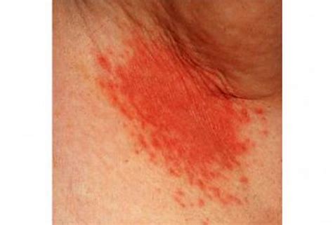 Armpit Rash