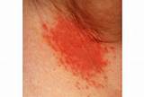Armpit Pimple Treatment Images