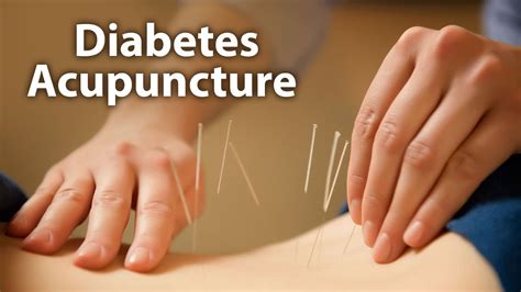Acupuncture For Diabetes Body N Soul Part 1 Youtube