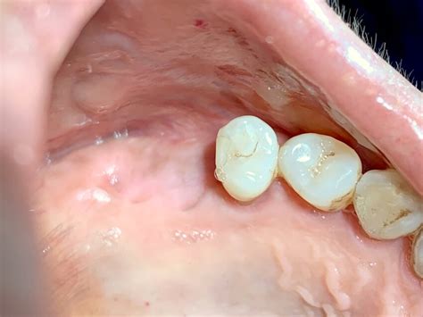 Initial Photo Of The Left Posterior Maxillary Alveolar Ridge With