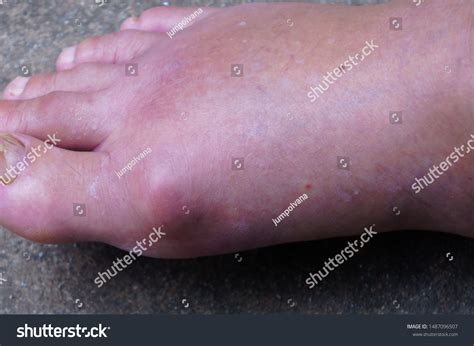Red Swollen Feet Gout Stock Photo 1487096507 Shutterstock