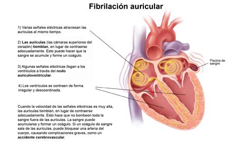 El Corazón Durante La Fibrilación Auricular La Fibrilación Auricular
