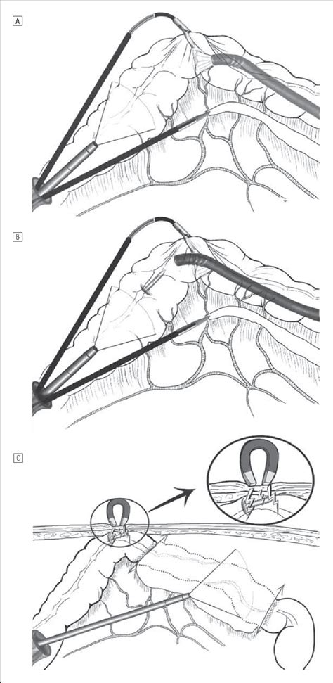 Figure 1 From Single Access Laparoscopic Sigmoidectomy As Definitive