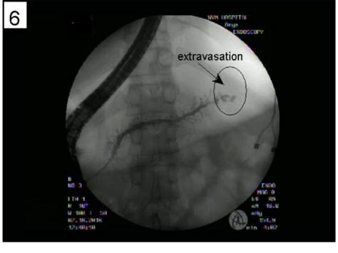 Ercp With Evidence Of Distal Pancreatic Extravasation Of Contrast