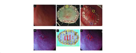 Endoscopic Images Of Gastric Cancer On The Anterior Wall Of The