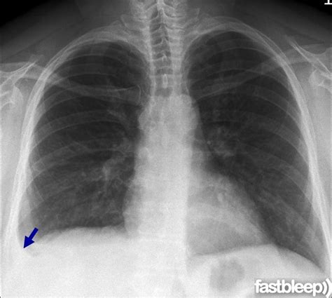If you miss a tension pneumothorax you risk your patient's. Pleural Effusion Chest X-ray | X ray, Pleural effusion