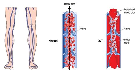 Introducción la trombosis venosa intracraneal (tvi), es. 7 factores de riesgo para desarrollar trombosis venosa ...