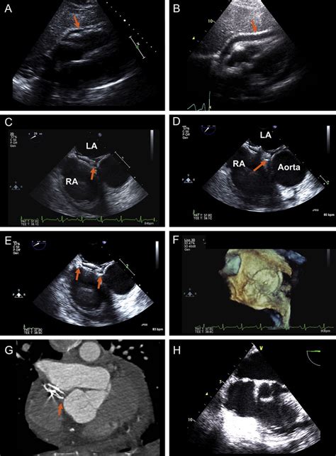 Early And Late Cardiac Perforation By Amplatzer Atrial Septal Defect