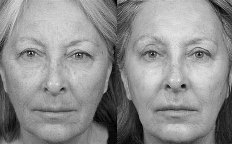 The Benefits Of Laser Skin Resurfacing With Co2 Fractional Laser Cocoon