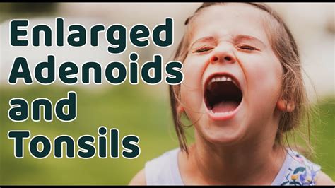 Enlarged Adenoids And Tonsils Youtube